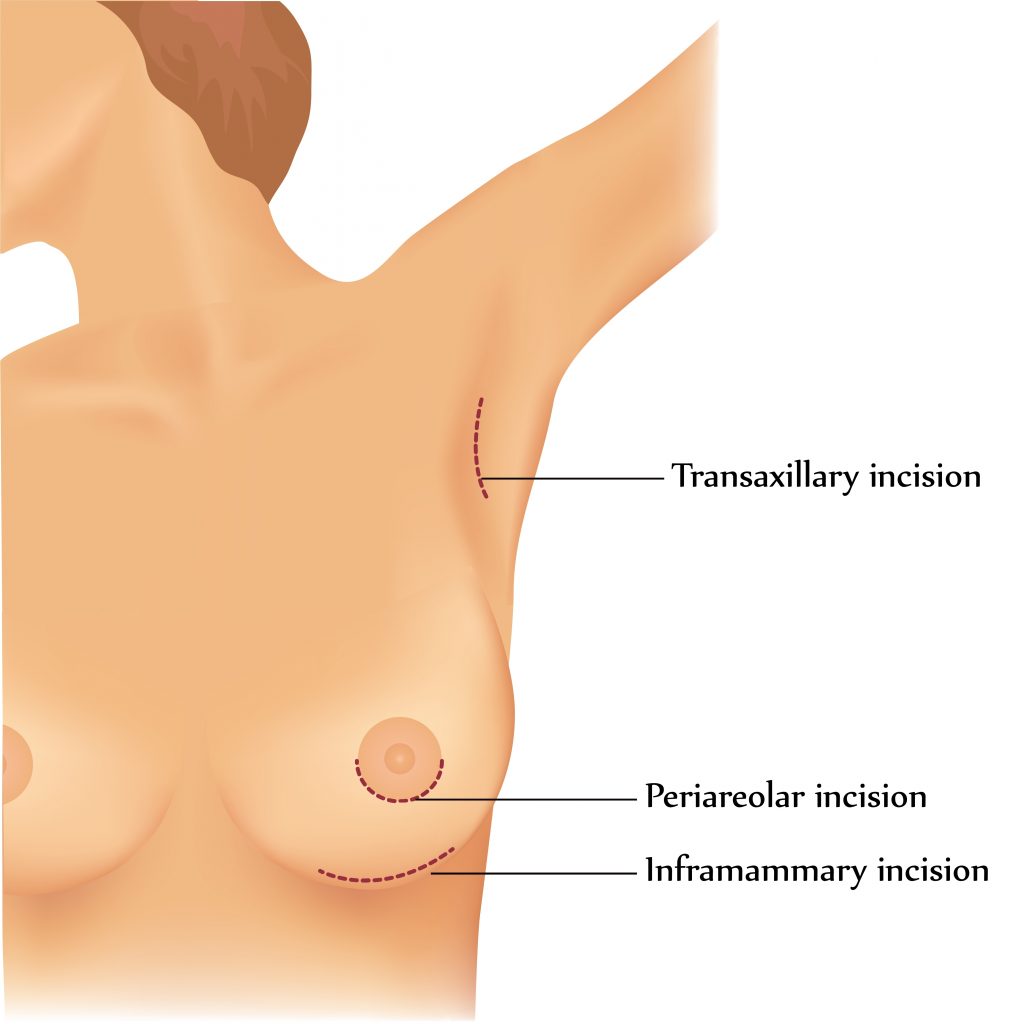 Breast implant : Choice of Incisions 