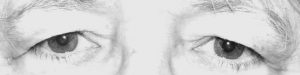 Dermatochalasis - Droopy Eyelid - Differentiate from Ptosis Correction