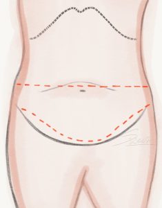 Abdominoplasty - Belt Tummy Tuck