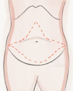 Abdominoplasty - Fleur De Lis Tummy Tuck