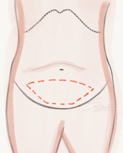 Abdominoplasty - Mini Tummy Tuck