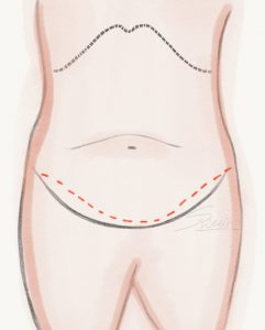 Abdominoplasty - Conventional Tummy Tuck