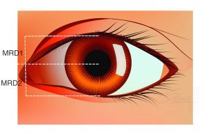Blepharoptosis Assessment - MRD measurement for droopy eyelid