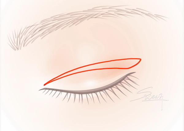 Incisional Blepharoplasty - Double eyelid surgery