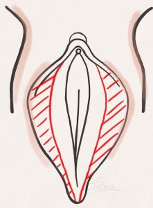 Labiaplasty - Trim method