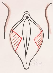 Labiaplasty - Wedge Excision Method