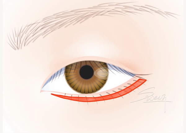 Lower Blepharoplasty - Eyebag Removal