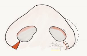 Rhinoplasty - Alarplasty during Nose Job