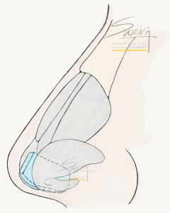 Rhinoplasty - Caudal Extension Graft of nose job