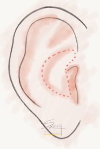 Rhinoplasty - Conchal (Ear) Cartilage Harvest