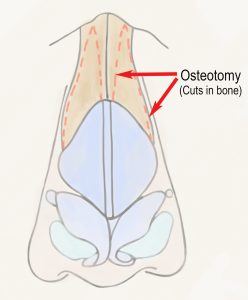 Rhinoplasty - osteotomy line of nose job