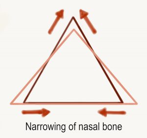 Rhinoplasty - osteotomy - narrowing of nasal bone triangle during nose job
