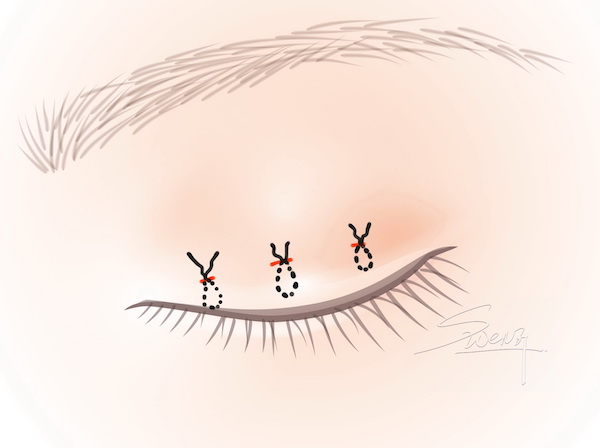 Suture Blepharoplasty - Scarless Double Eyelid Surgery