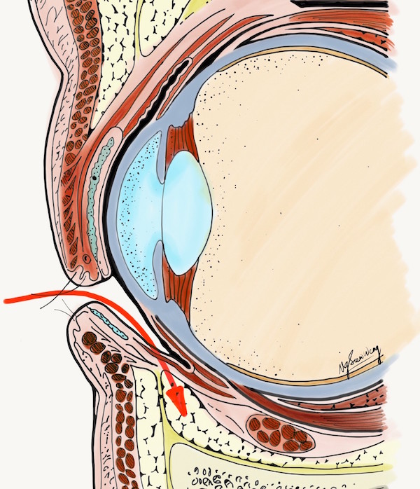 Lower blepharoplasty - Transconjunctival - Scarless Eyebag Removal