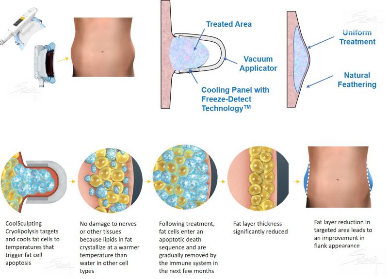 Coolsculpting - Cryolipolysis - Slimming Weight Loss - Mechanism of Fat Freeze