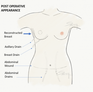 Breast Reconstruction - TRAM Flap - Post operative appearance with drains - breast cancer surgery