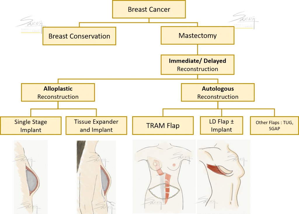 Breast Reconstruction Protocol - best options after breast cancer surgery