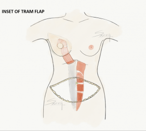 TRAM flap placed inset into the remnant breast skin envelop - breast cancer surgery