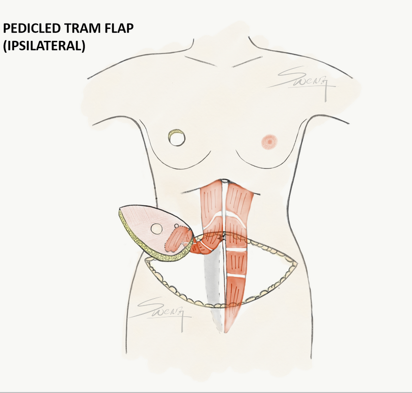 Pedicled TRAM flap harvest after mastectomy for immediate breast reconstruction - breast cancer surgery
