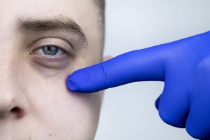Everything To Know When Considering Eye Bag Removal Surgery